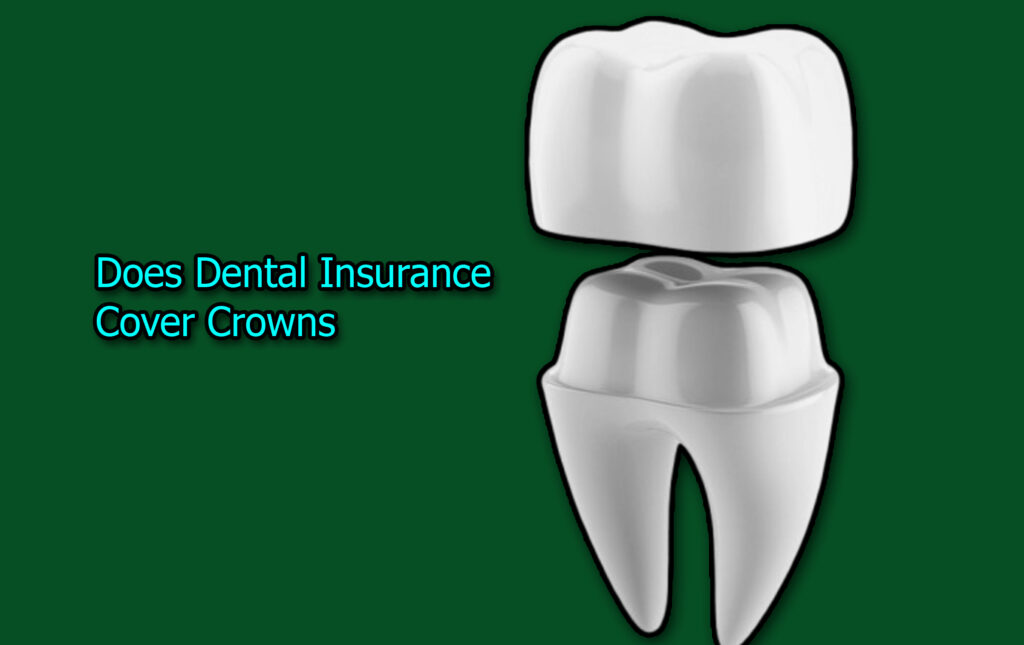 Does Dental Insurance Cover Crowns